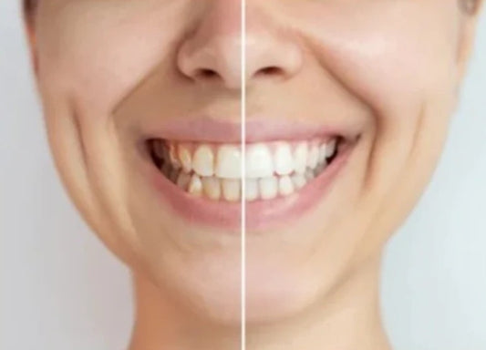 Bestsmile Premium tannbleking strips - 28 pk -4 ukers bruk - 84 % rabatt