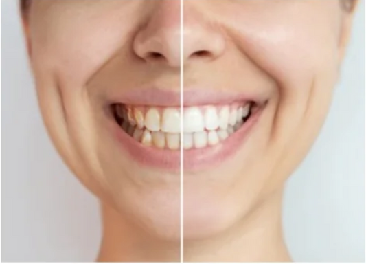 Bestsmile Premium Tannblekingsstrips - 14 par - 80 % rabatt