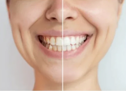 Vareparti Bestsmile Tannblekingsstrips 1000 pk – Grossist & Videresalg